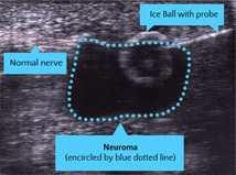 Tratamiento del neuroma de Morton con criocirugia