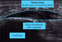 Tratamiento de la fascitis plantar con criocirugia